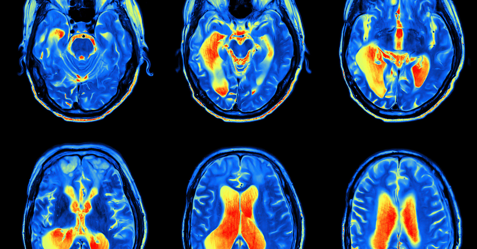 Nuclear medicine - MRI scan image of brain